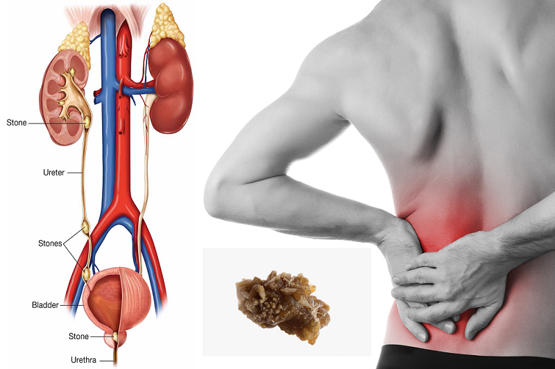 Kidney stone treatment
